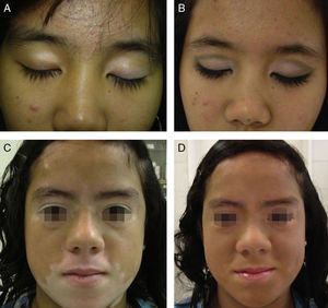 A y B. Vitíligo segmentario antes y después de la sesión de maquillaje corrector. C y D. Vitíligo segmentario antes y después de la sesión de maquillaje corrector.