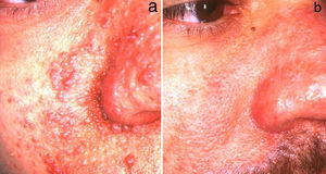 A. Angiofibromas faciales localizados en la nariz, la mejilla y el surco nasolabial. B Resultado tras tratamiento con láser de CO2. Cortesía del Dr. Pablo Boixeda.