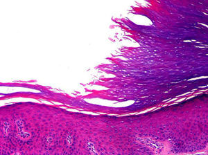 Entre la capa córnea normal sana y la capa córnea adelgazada de la hipoqueratosis se observa que los corneocitos muestran un aspecto desflecado y más eosinófilo que otros adyacentes (hematoxilina-eosina ×200) (gentileza del Dr. Luis Requena).