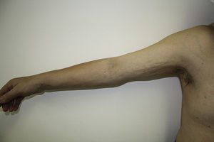 Edema del brazo derecho, con aspecto abollonado en su cara interna y aumento del diámetro del antebrazo.