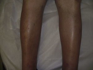 Edema y eritema bilateral de ambas piernas.