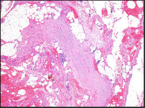 Detalle histológico de los septos subcutáneos engrosados y edematosos con presencia en estos y en la fascia superficial de un infiltrado inflamatorio mixto. HE x100