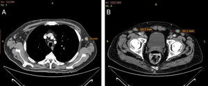 A. Adenopatías mediastínicas de diferente tamaño. B. Adenopatía inguinal izquierda palpable de 3×2cm.