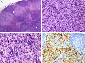 Afectación ganglionar por la histiocitosis de células de Langerhans (A [H-E ×2]), senos subcapsulares ocupados y expandidos por una población celular predominantemente mononuclear con algunos eosinófilos (B [H-E ×20]). Un mayor aumento (C [H-E ×40]) permite ver en detalle los eosinófilos (flechas) y los núcleos elongados con hendiduras o plegamientos de las células de Langerhans (D [CD1a] ×10). Expresión positiva de CD1a en las células de Langerhans.