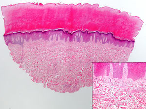 Histológicamente se observa una dermis engrosada a expensas del engrosamiento de los haces de colágeno, junto con un ligero aumento del número de fibroblastos, sin inflamación. La epidermis muestra hiperqueratosis ortoqueratósica y acantosis (hematoxilina-eosina ×5). En el recuadro de la derecha se muestra a mayor detalle el aumento de los haces de colágeno y de los fibroblastos (hematoxilina-eosina ×20).