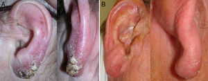 Visión frontal y lateral. A. Placa infiltrada eritematosa con ulceración central y costra seropurulenta de 16×25mm en el LA izquierdo y pústulas coalescentes en el antehélix. B. Edema de consistencia blanda e infiltración nodular hiperémica de 9,5×10mm en el LA derecho.