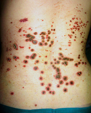 Múltiples pápulas y placas dorso-lumbares en paciente 6, con tapón hiperqueratósico central y halo eritematoso.