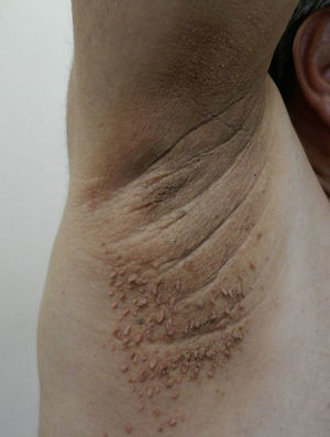 Acrocordones, incontables pápulas pediculadas color piel en la axila de un paciente que presenta adicionalmente acantosis nigricans.