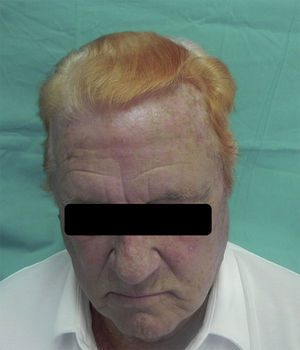 Decoloración amarillo-anaranjada del cabello del cuero cabelludo.