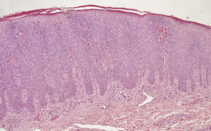 H-E ×20. Epidermis acantótica con importante infiltrado pagetoide de linfocitos de morfología atípica.