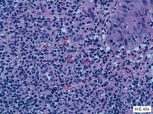 En la biopsia obtenida del margen de la úlcera se observa un infiltrado inflamatorio mixto con presencia de linfocitos, histiocitos, algunos macrófagos y amastigotes intra y extracelulares (flechas rojas) (H-E ×40).