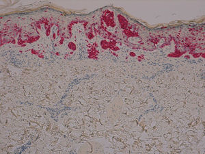 Melanocitos dispuestos en nidos en la capa basal de la epidermis con la presencia de algún melanocito individual dispuesto en capas más altas (Melan-A, ×4).