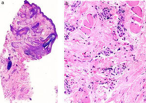 A. Panorámica, capas superficiales sin alteraciones, con presencia de agregados linfocitarios en las capas profundas (hematoxilina-eosina ×25). B. Detalle con presencia abundantes eosinófilos dispersos en el estroma (hematoxilina-eosina ×200).