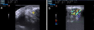 A. Imagen ecográfica de la lesión: nódulo mal delimitado en la dermis, con haces hiperecoicos e hipoecoicos, formando una imagen en «ovillo de lana» (señalado mediante asterisco). B. Doppler color de la lesión, donde se objetiva hipervascularización. Nótese también la presencia de un halo hiperecoico rodeando la masa (señalado mediante asterisco).