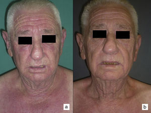 A. Edema y eritema facial en el caso n.° 3 antes de la cirugía. B. Aspecto de la cara del mismo caso a los 10 días de la cistectomía radical.
