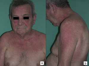 Erupción eritematoviolácea fotodistribuida en la cara, la porción superior del tronco y la región proximal de la superficie de extensión de las extremidades superiores del caso n.° 2.
