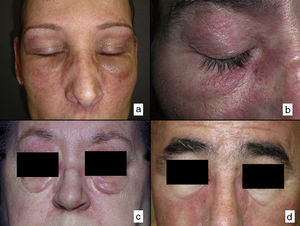 Distintos grados de rash heliotropo. A. Edema marcado predominante (caso n.° 5). B. Predominio de eritema (caso n.° 1). C. Edema y eritema marcados (caso n.° 8). D. Predominio de edema (caso n.° 4).
