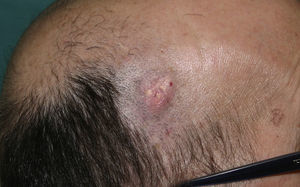 Tumoración subcutánea de varios centímetros, con zonas blanquecinas lobuladas de consistencia firme en la zona parietal izquierda de un paciente con enfermedad de Steinert.