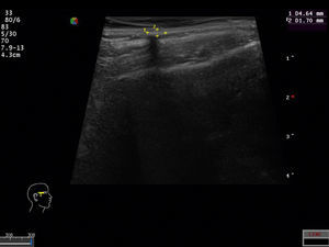 Ecografía dermatológica que muestra un nódulo hiperecoico con refuerzo periférico y sombra posterior.