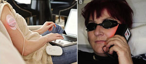 TFD ambulatoria50 con fuentes de luz portátiles. A. Ambulight® (Ambicare Health Ltd., St Andrews, Fife, UK) (http://www.ambicarehealth.com/ambulight-pdt/): LED adhesivo de luz roja —pico de emisión 640+–25 nm— que emite una dosis de 75J/cm2 con baja irradiancia (7mW/cm2) a lo largo de 3h49. Imagen cortesía de Ambicare Heath Ltd. B. AK-derm® (Sellas GmbH, Ennepetal, Alemania): LED de alta irradiancia (70-80mW/cm2) que emite 37J/cm2 en 8min, con un pico de emisión en 630nm+–5nm. Imagen cortesía del Dr. Helger Stege (Klinikum Lippe, Detmold, Alemania).