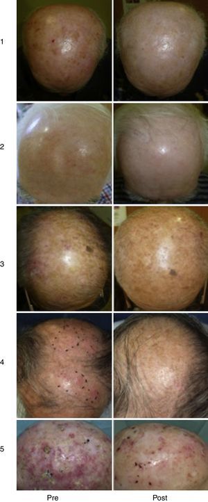 Tratamiento de QA múltiples con TFDLD. Las imágenes de la columna izquierda corresponden al aspecto de las lesiones antes del tratamiento; las imágenes de la columna derecha corresponden al resultado obtenido 3 meses tras una sesión de TFDLD (casos 1-3: Gerencia de Gestión Integrada de Vigo; Complejo Hospitalario Universitario de Vigo), 8 meses tras una sesión de TFDLD y 4 meses tras 2 sesiones de TFDLD (casos 4 y 5 respectivamente, Hospital San Jorge Huesca).