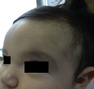 A soft, mobile, asymptomatic nodule in the frontal midline area of a 4-month-old girl.