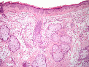 Piel con abundantes histiocitos xantomizados con microvacuolas y otros con macrovacuolas localizados en dermis reticular, sugestivos de reacción histiocitaria a material de relleno (hematoxilina-eosina 10×).