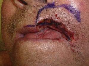 Defect of 3.5cm×2cm after 3 stages of Mohs micrographic surgery to the left upper lip. There is a large defect of the muscle and mucosa and a small skin defect.