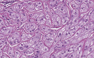 H-E ×40. Células de morfología poligonal, con abundante citoplasma granular eosinófilo, con núcleos grandes y vesiculosos, dispuestas con un patrón fascicular y entrelazado.
