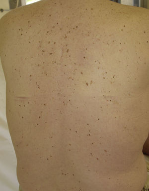 Lesiones melanocíticas eruptivas en un paciente tratado con sorafenib. Figura cedida por las Dras. Tuneu y López Pestaña del Hospital Donostia-San Sebastián.