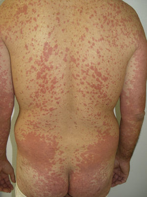 Erupción cutánea tipo rash cutáneo/toxicodermia en paciente en tratamiento con sorafenib. Figura cedida por las Dras. Tuneu y López Pestaña del Hospital Donostia-San Sebastián.