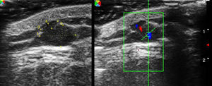 Metástasis de melanoma: lesión localizada en el tejido celular subcutáneo constituida por 2 lóbulos hipoecoicos con refuerzo posterior que semejan un quiste epidérmico. El doppler mostró una abundante vascularización en el interior de ambas lesiones.