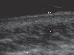 Ecoestructura de la piel normal. Der: dermis; Ep: epidermis; Fas: fascia; Hyp: tejido celular subcutáneo.