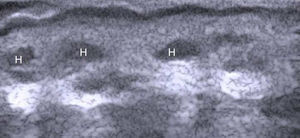 Implantes de ácido hialurónico (H). El patrón del ácido hialurónico inicialmente es vesicular.