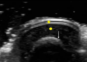 Corte transversal de la uña en modo B. Estrella: tabla ungueal; círculo: lecho ungueal; flecha: falange distal (cortesía Dr. Cerezo).