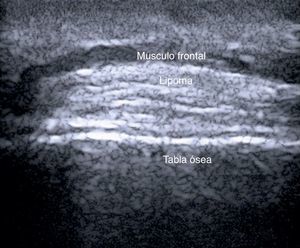 Lipoma subfrontal: el aumento en número de tabiques subcutáneos genera mayor ecogenicidad. La ecografía permite una aproximación al diagnóstico y la localización preoperatoria de la lesión.