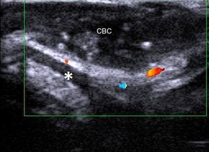 Carcinoma basocelular (CBC) auricular. Asterisco: cartílago auricular.
