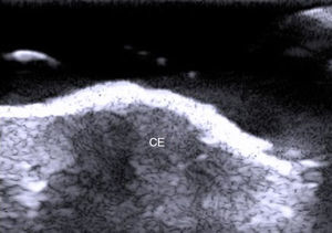 Carcinoma epidermoide (CE) con bordes irregulares que presenta abundante flujo doppler que indica presencia de neovascularización.