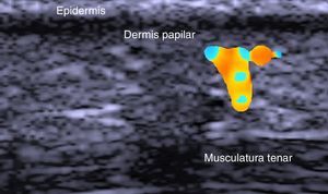 Psoriasis palmar. Aumento de flujo local en área hipoecoica subepidérmica que indica inflamación.