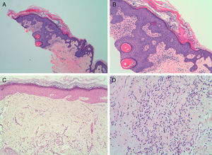 A y B. Biopsia cutánea de lesión de pitiriasis rubra pilaris que muestra hiperqueratosis paraqueratósica alternante. Hematoxilina-eosina ×4 (A) y hematoxilina-eosina×10 (B). C y D. Biopsia de cuero cabelludo que muestra fibrosis dérmica perifolicular estrellada. No se observa infiltrado inflamatorio perifolicular. Hematoxilina-eosina×10 (C) y hematoxilina-eosina×20 (D).