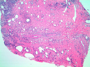 Imagen microscópica que muestra fibrosis en la dermis papilar y reticular además de múltiples vacuolas vacías donde se hallaba la parafina (hematoxilina-eosina×4).