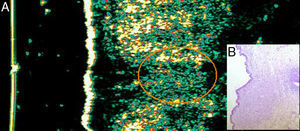 Caso 5. Mujer de 71 años con carcinoma basocelular dorsal. A. Imagen ecográfica (20Mhz) de la lesión donde se observa una estructura hipoecoica ovalada, mal definida subepidérmica de la que parte una prolongación hipoecoica mal definida que penetra en la dermis subyacente y que sugiere infiltración. B. Imagen histológica de la lesión con H-E×4. Se observan nidos de células basaloides que infiltran la dermis subyacente compatible con CBC infiltrativo.
