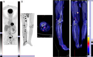 Imagen PET/TAC mostrando imágenes de PET (A) y superposición (B), en la que se muestran múltiples focos hipermetabólicos en relación con la afectación ganglionar y subcutánea múltiple