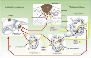 Papel de la linfangiogénesis en la diseminación a distancia de las células neoplásicas. Representa esquemáticamente el papel de la linfangiogénesis en el desarrollo de las metástasis linfáticas y hematógenas. Las células tumorales liberan VEGF-A y VEGF-C, induciendo la proliferación de los vasos linfáticos en tejido conectivo peritumoral (1). Al mismo tiempo, los factores VEGF-A y -C son transportados hacia el ganglio centinela (2), induciendo la proliferación de los vasos sanguíneos y linfáticos en el mismo (nicho pre-metastásico). Una vez que las células tumorales llegan al primer ganglio se produce un incremento de los factores VEGF-A y C, y de nuevo estos son transportados hacia los ganglios distantes (3), facilitando la producción de metástasis hacia los ganglios distantes (4 y 5), así como metástasis hematógenas a distancia, a través del conducto torácico o sistema vascular sanguíneo (6 y 7).