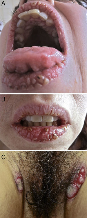 (A, B) Painful white verrucous papules, fissures, erosions, and crusts on the vermillion border of the lips and the hard palate (cobblestone pattern); sulci and gyri on the dorsum of the tongue (cerebriform tongue). © Oozing, raised erythematous plaques with a verrucous surface on the inguinal folds.