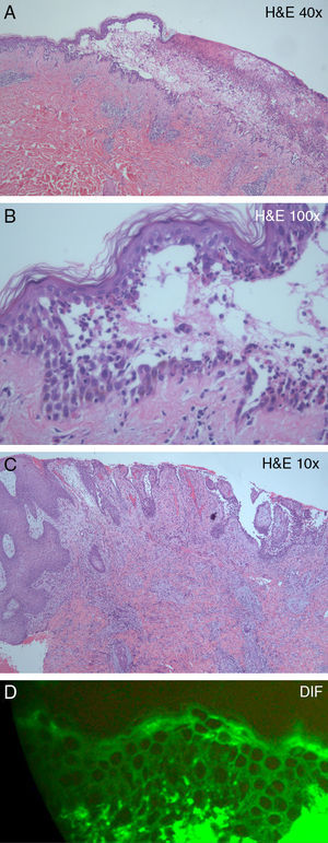 (A) Intraepidermal blister and a dense epidermal and dermal inflammatory infiltrate (hematoxylin–eosin, original magnification, ×10). (B) Suprabasal acantholysis and inflammatory infiltrate, rich in neutrophils and eosinophils (hematoxylin–eosin, original magnification, ×40). (C) Pseudoepitheliomatous epidermal hyperplasia and dense inflammatory dermal infiltrate (hematoxylin–eosin, original magnification, ×10). (D) Direct immunofluorescence showing immunoglobulin G intercellular epidermal deposits.