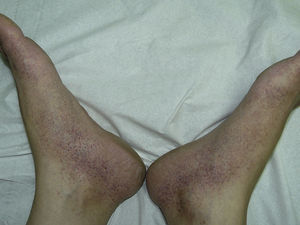 Exantema purpúrico en «calcetín».