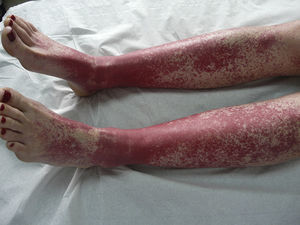 Púrpura palpable en las piernas compatible con vasculitis, confirmado histológicamente.