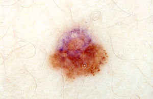 Dermatoscopia de un melanoma de extensión superficial de 4mm de diámetro y 0,5mm de espesor. Se aprecia asimetría estructural (probable inestabilidad genética), glóbulos periféricos focales (crecimiento) y punteado gris en el tercio superior (regresión).