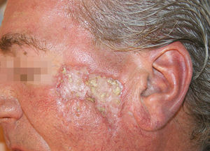 Primera visita. Placa de aspecto cicatricial central, deprimida y de borde sobreelevado cigomática izquierda.